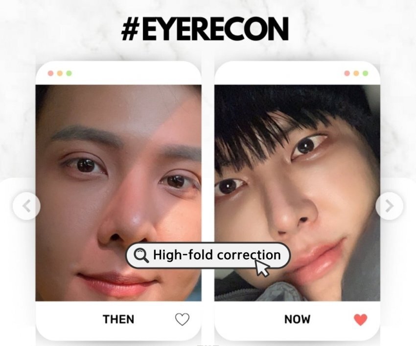 동남아에서 유행하는 쌍꺼풀 줄이는 수술