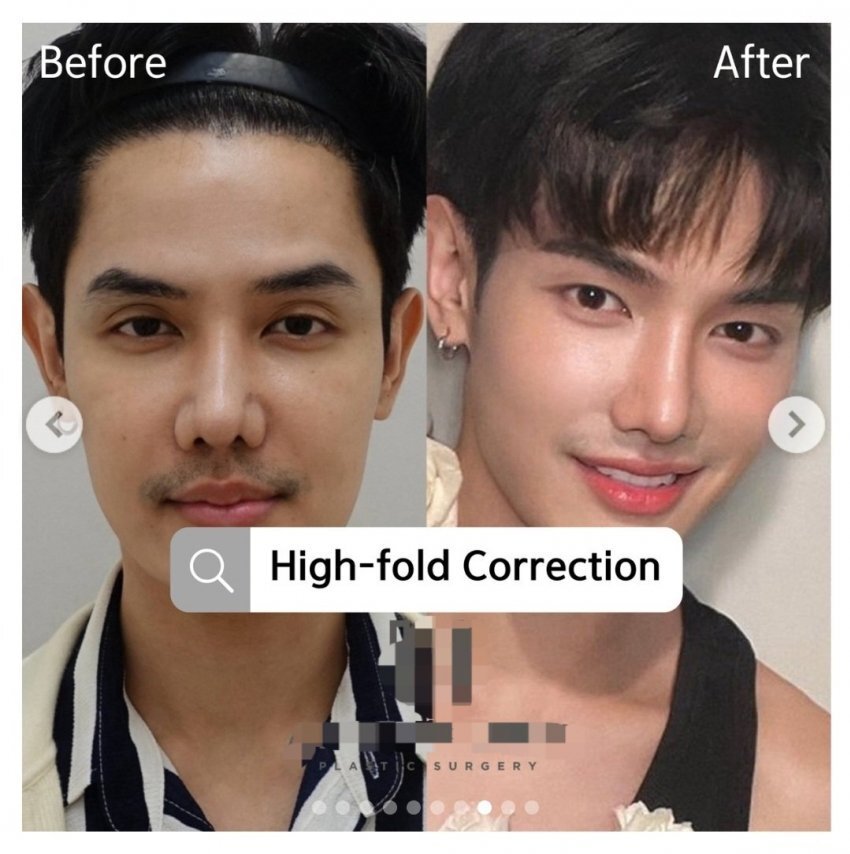 동남아에서 유행하는 쌍꺼풀 줄이는 수술