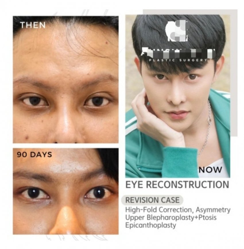 동남아에서 유행하는 쌍꺼풀 줄이는 수술