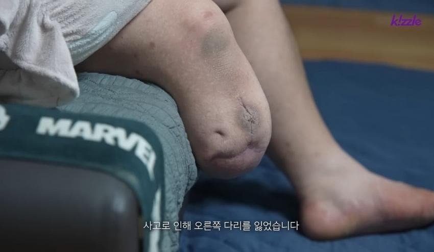 다리가 절단된 조선업 청년